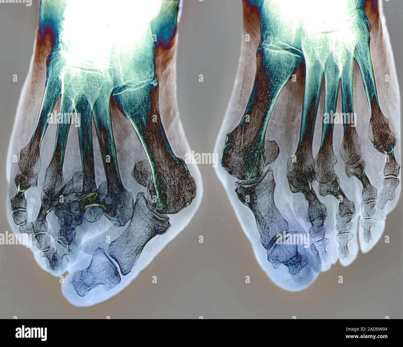 Bunions. Xray of a section through the feet of an 82yearold patient
