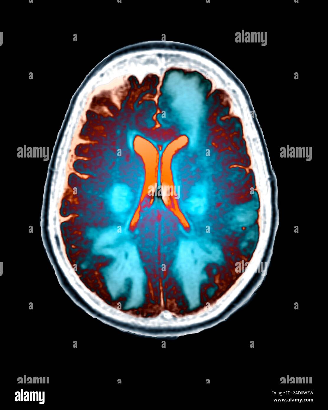 Brain in toxic encephalopathy. FLAIR magnetic resonance imaging (MRI ...