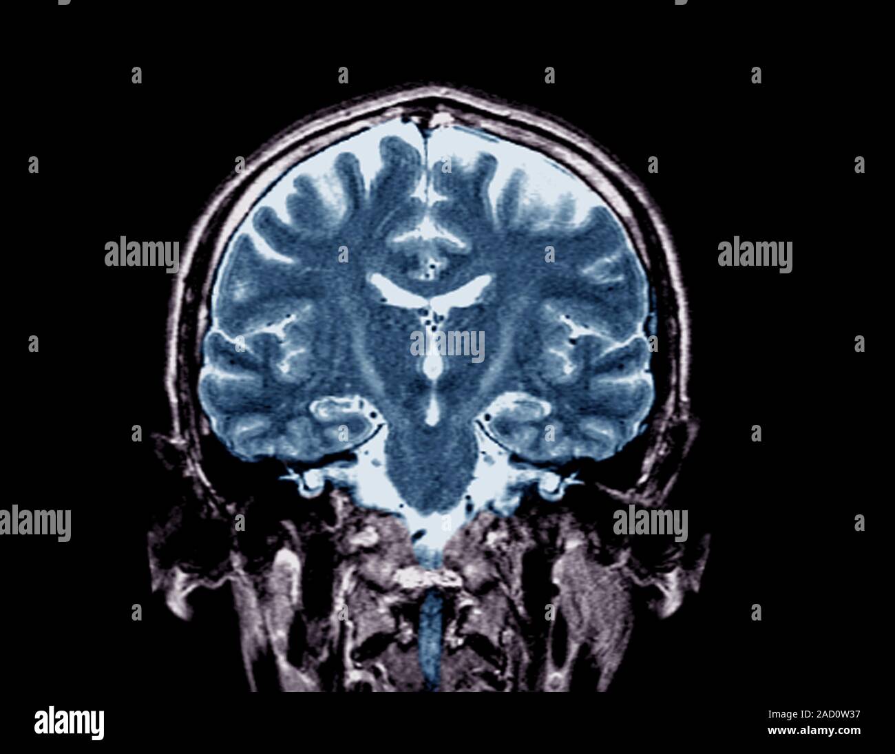 Brain in motor neurone disease. FLAIR magnetic resonance imaging (MRI ...