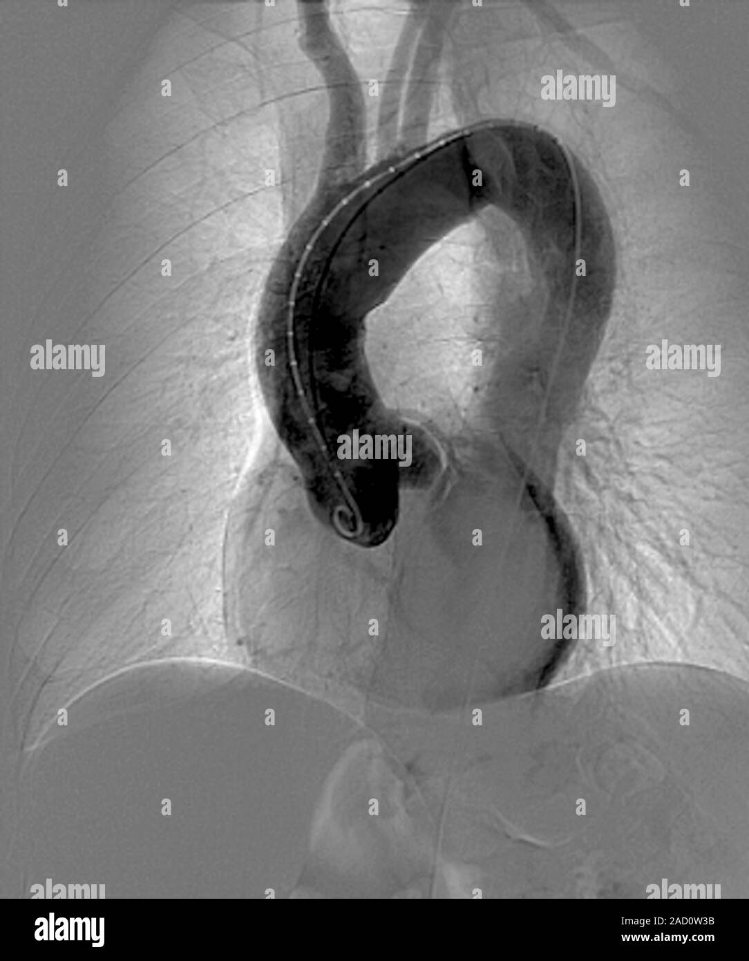 Aortic aneurysm in hypertension, X-ray. Angiogram of a section through ...