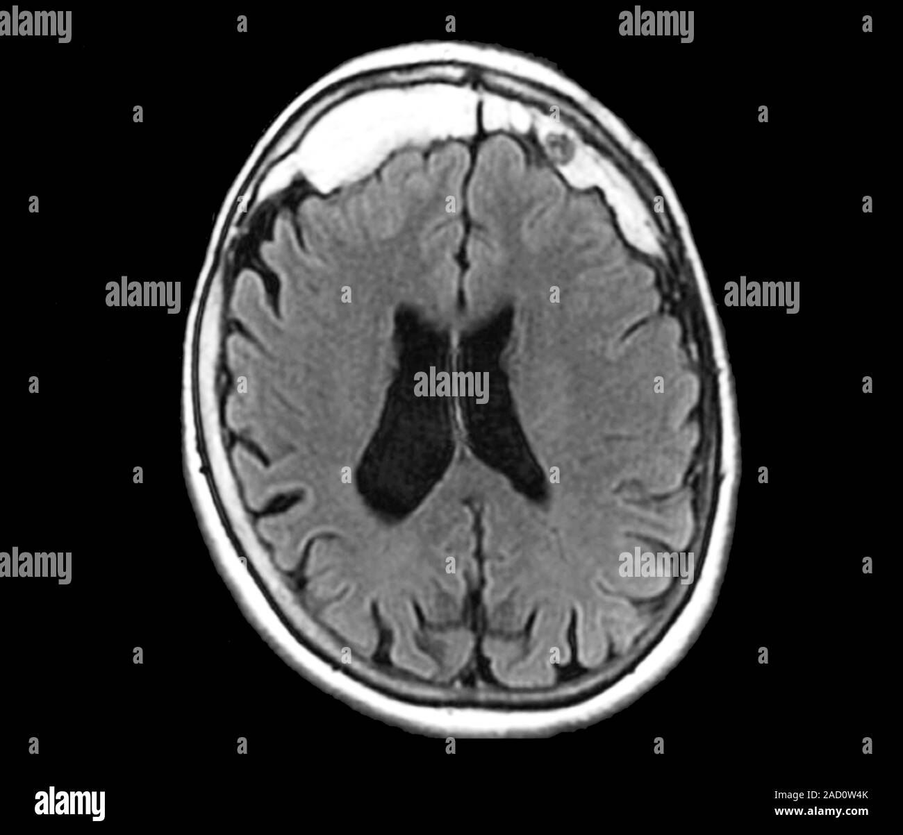 Excess skull growth. Magnetic resonance imaging (MRI) scan of an axial ...