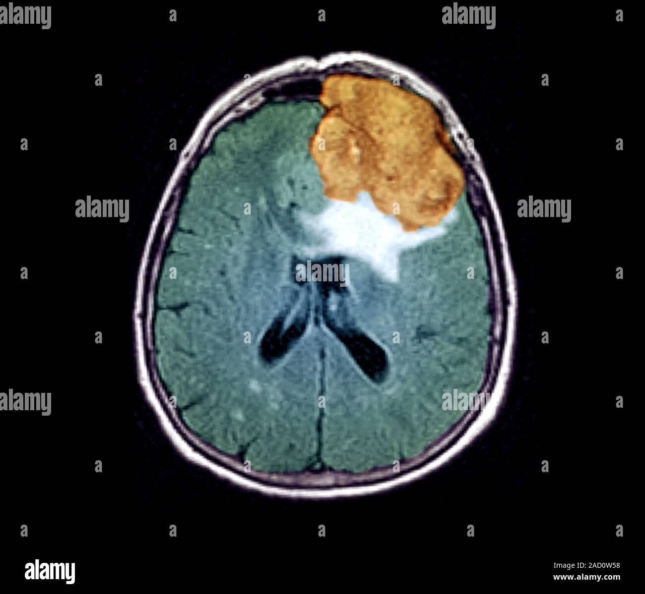 Brain cancer. Coloured magnetic resonance imaging (MRI) scan of an ...