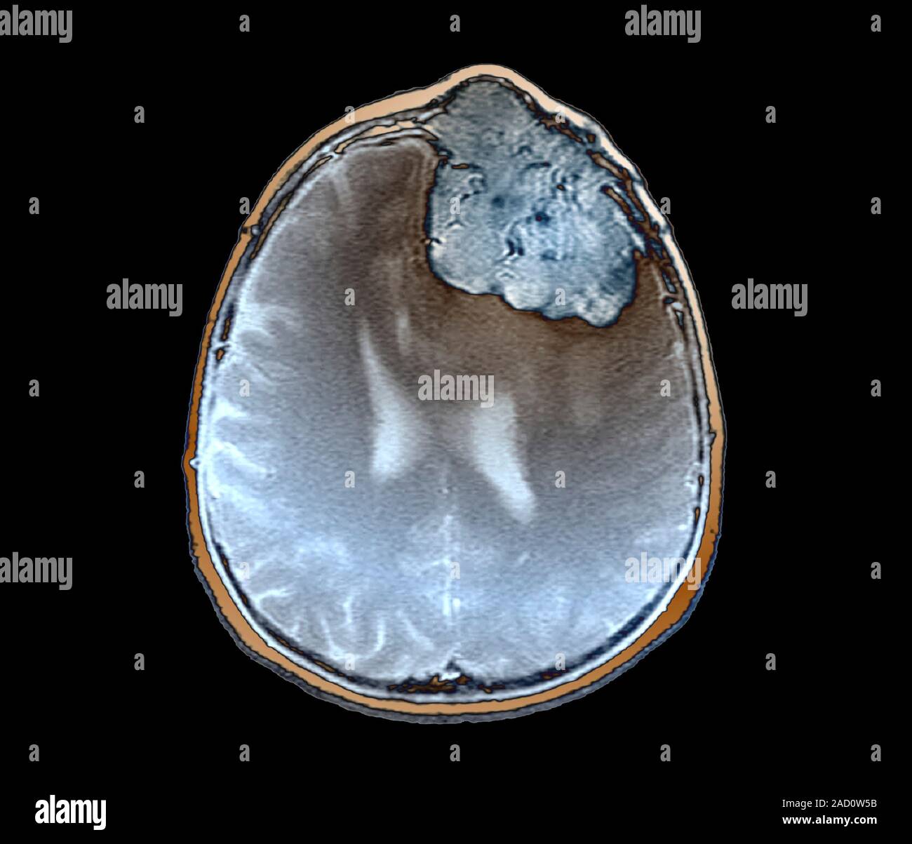 Brain cancer. Coloured magnetic resonance imaging (MRI) scan of an ...