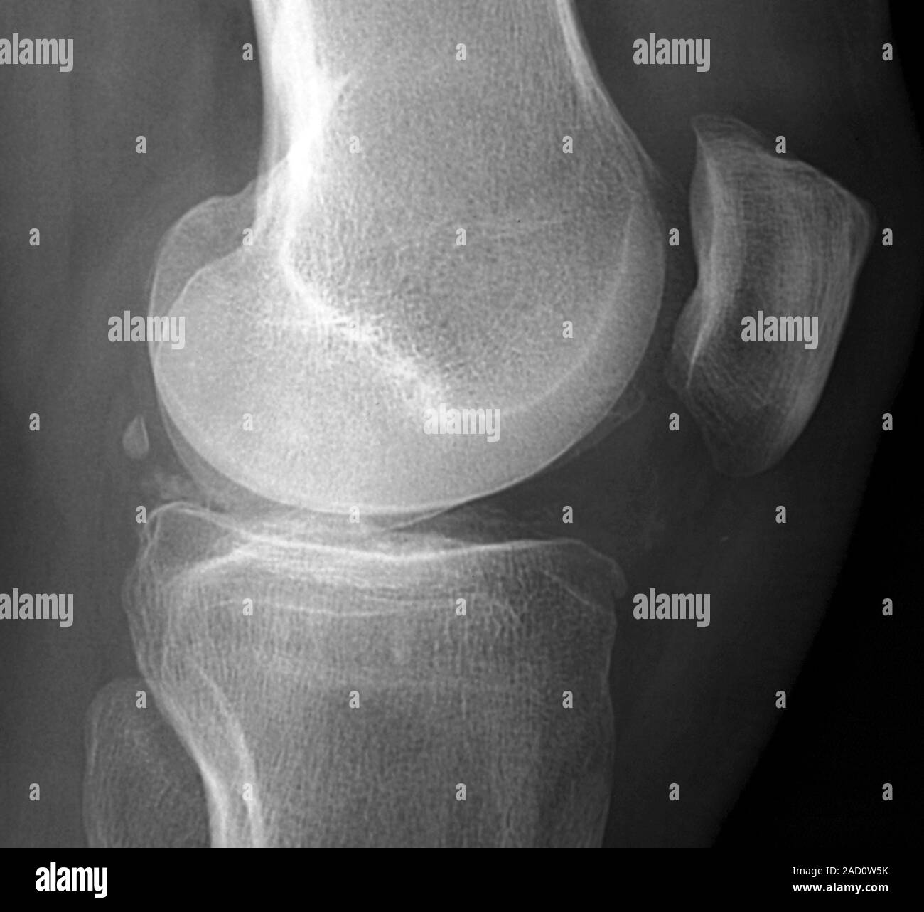 Calcification in the knee. Xray of a section through the knee of a 40