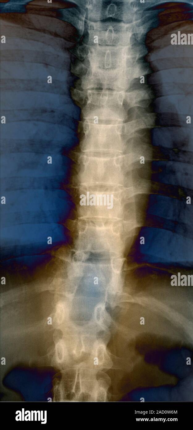 Spine in Pott's disease. Xray of a section through the spine of a 22