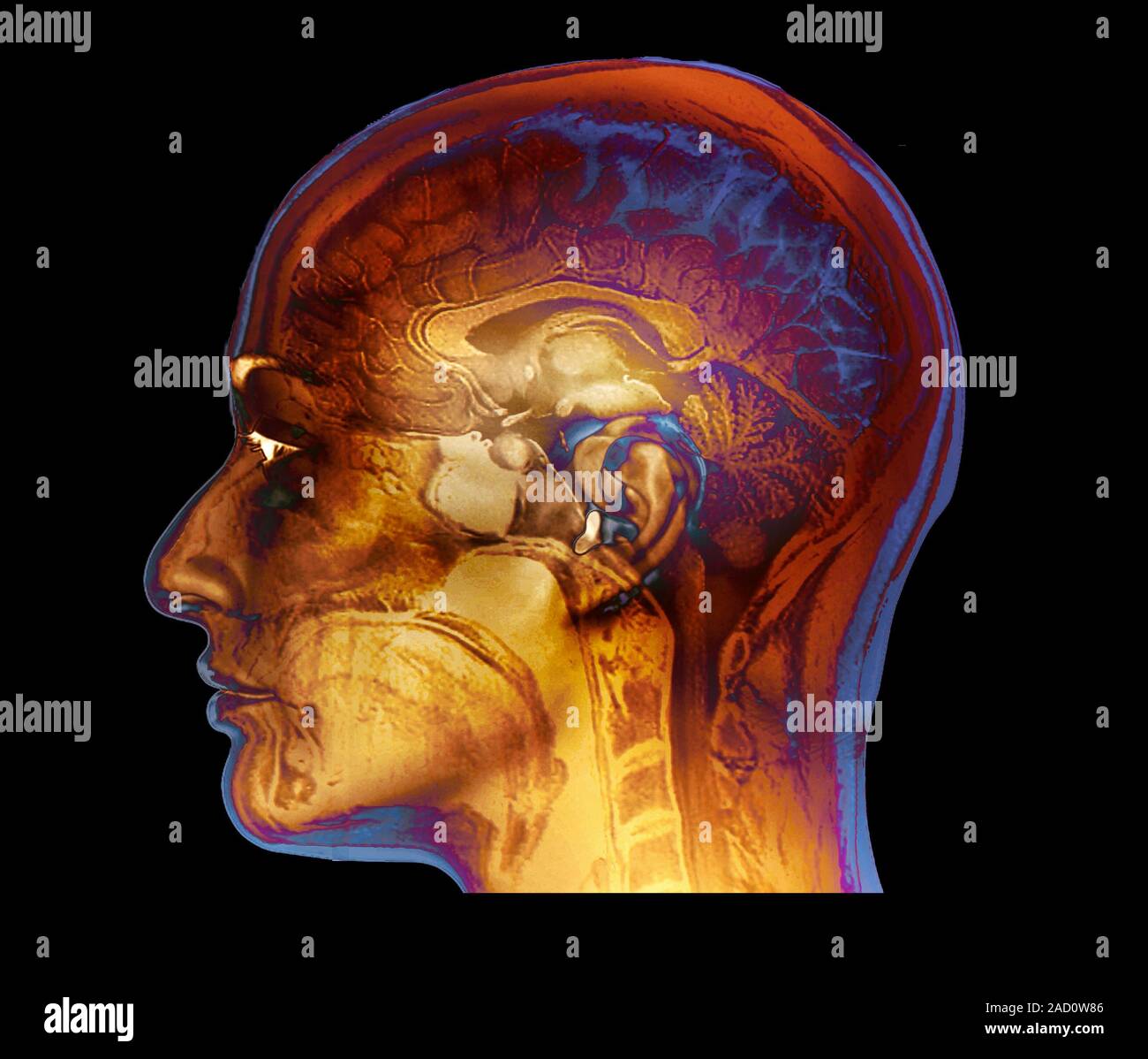 Auditory brain. Coloured magnetic resonance imaging (MRI) scan of the ...