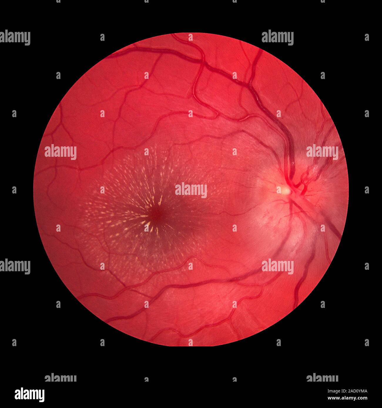 Neuroretinitis and optic disc oedema. Fundus photograph of the interior