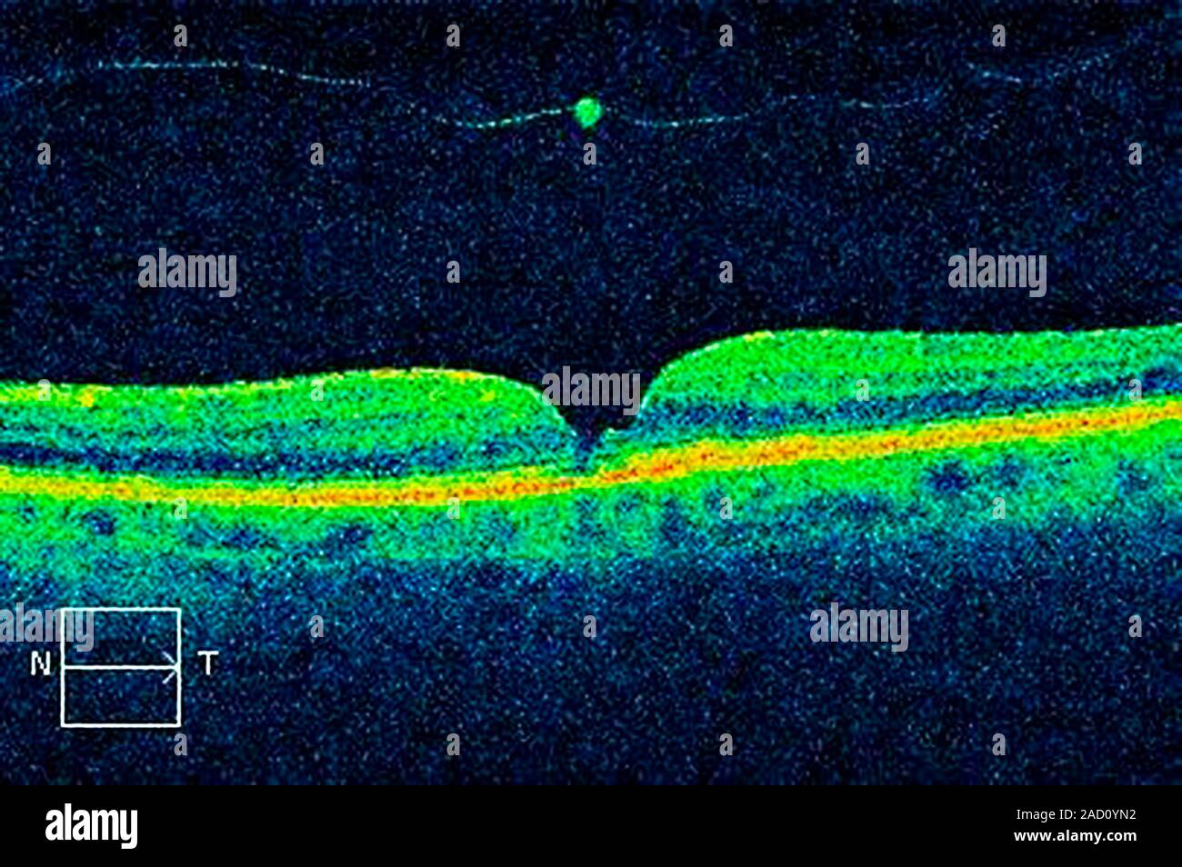 Vitreous detachment of the eye. Optical coherence tomography (OCT) scan