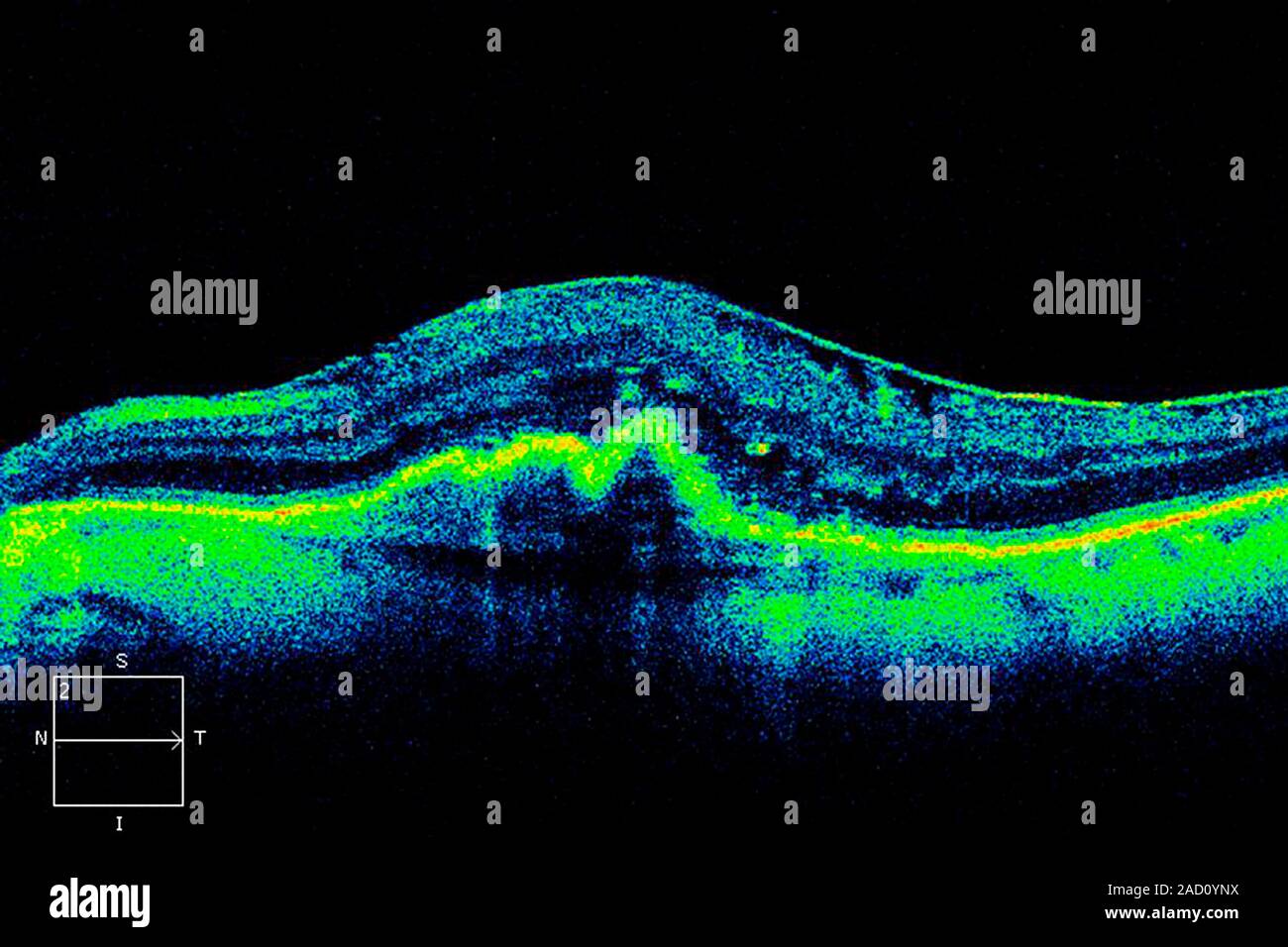 Macular degeneration optical coherence tomography oct scan of a