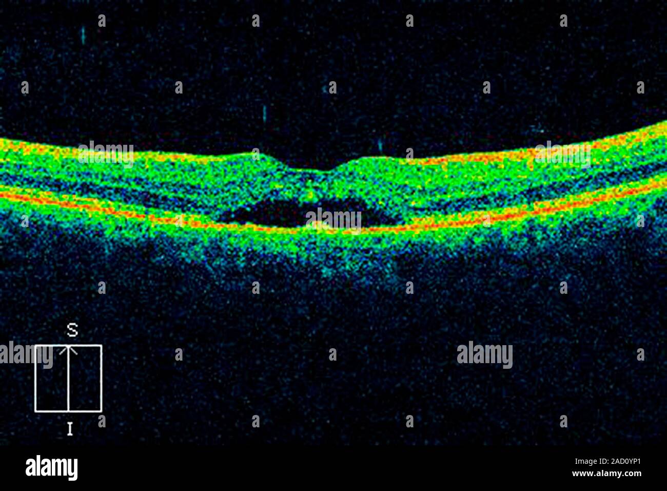 Macular degeneration. Optical coherence tomography (OCT) scan of a