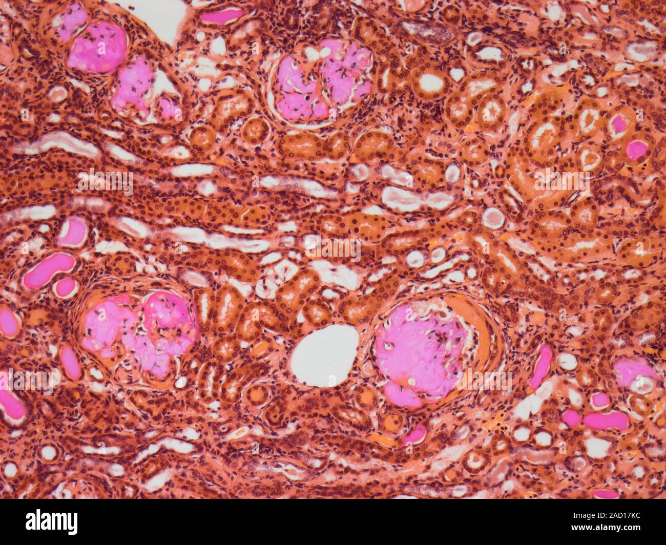 Renal Amyloidosis. Light micrograph of a human kidney showing amyloid ...