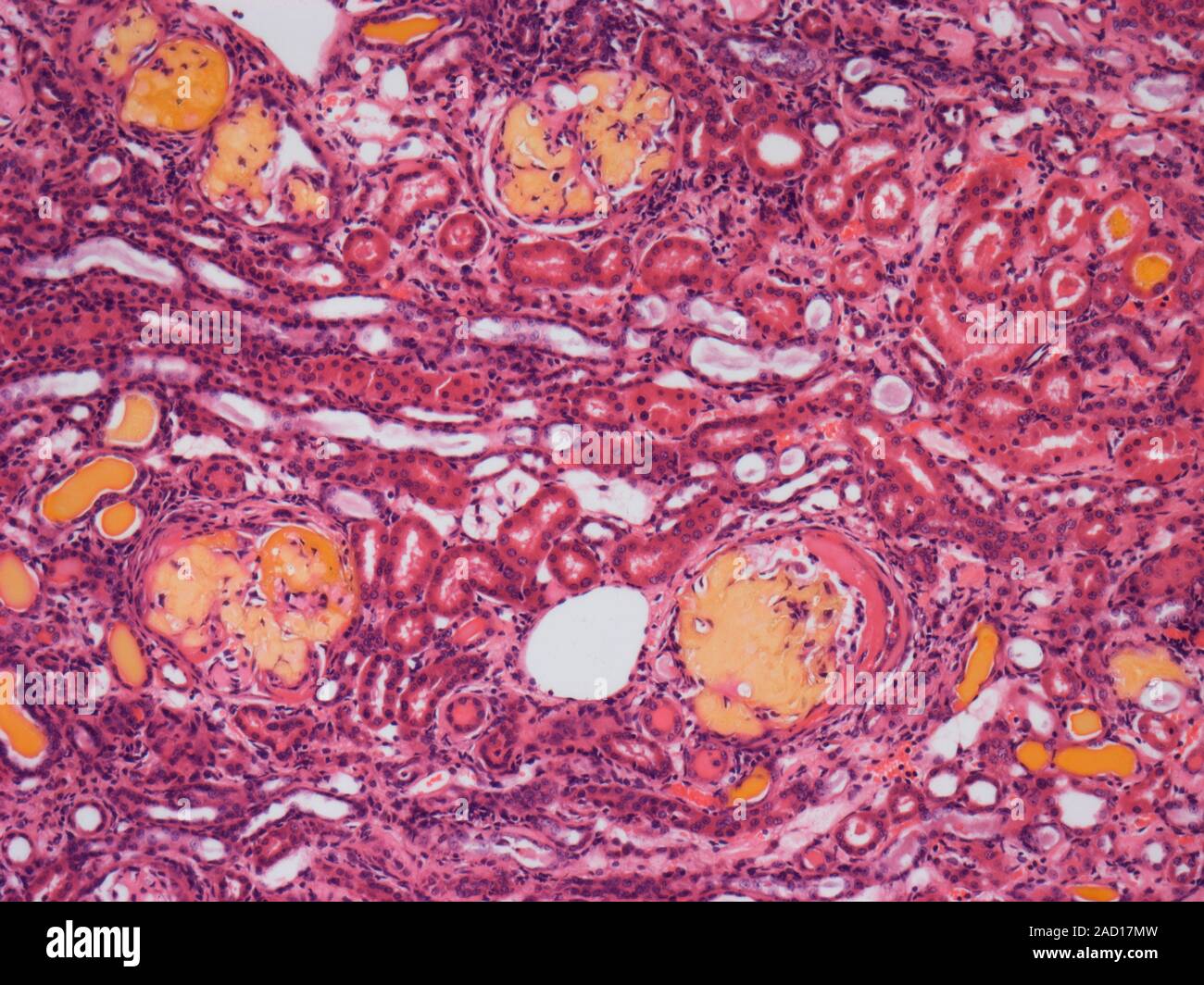 Renal Amyloidosis. Light micrograph of a human kidney showing amyloid ...