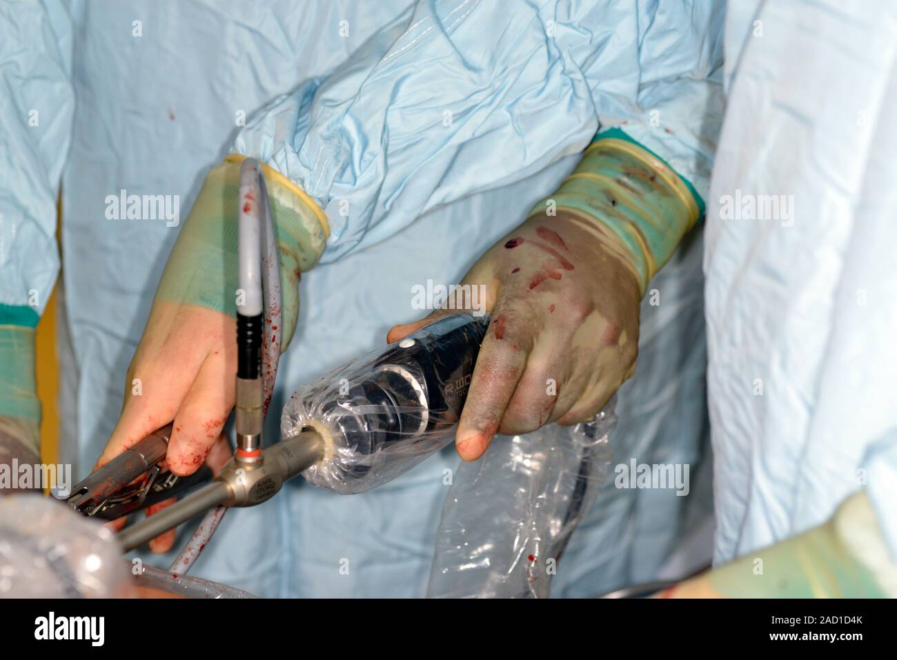 Endoscopic bariatric surgery. Closeup of surgeons using endoscopes to