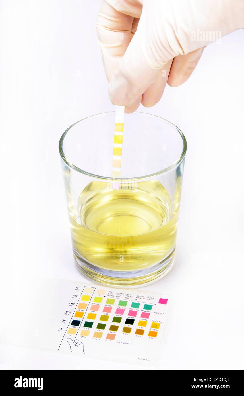 Home urine test. Home test kit for testing urine for signs of heart
