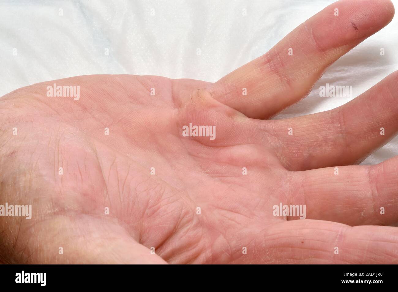 Dupuytren's contracture of a patient's hand. This condition causes one ...