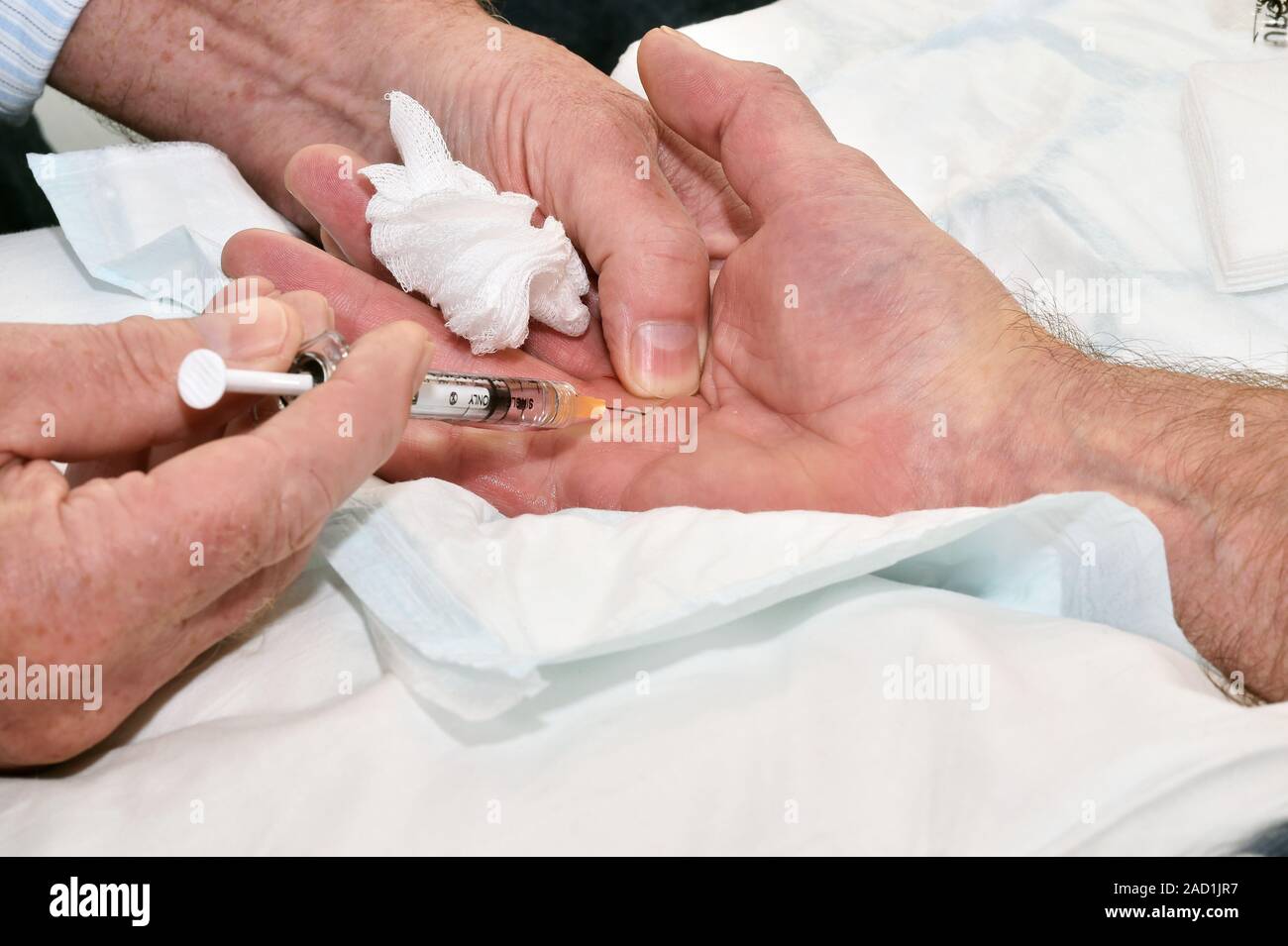 Dupuytren's contracture treatment. Injection of collagenase into the