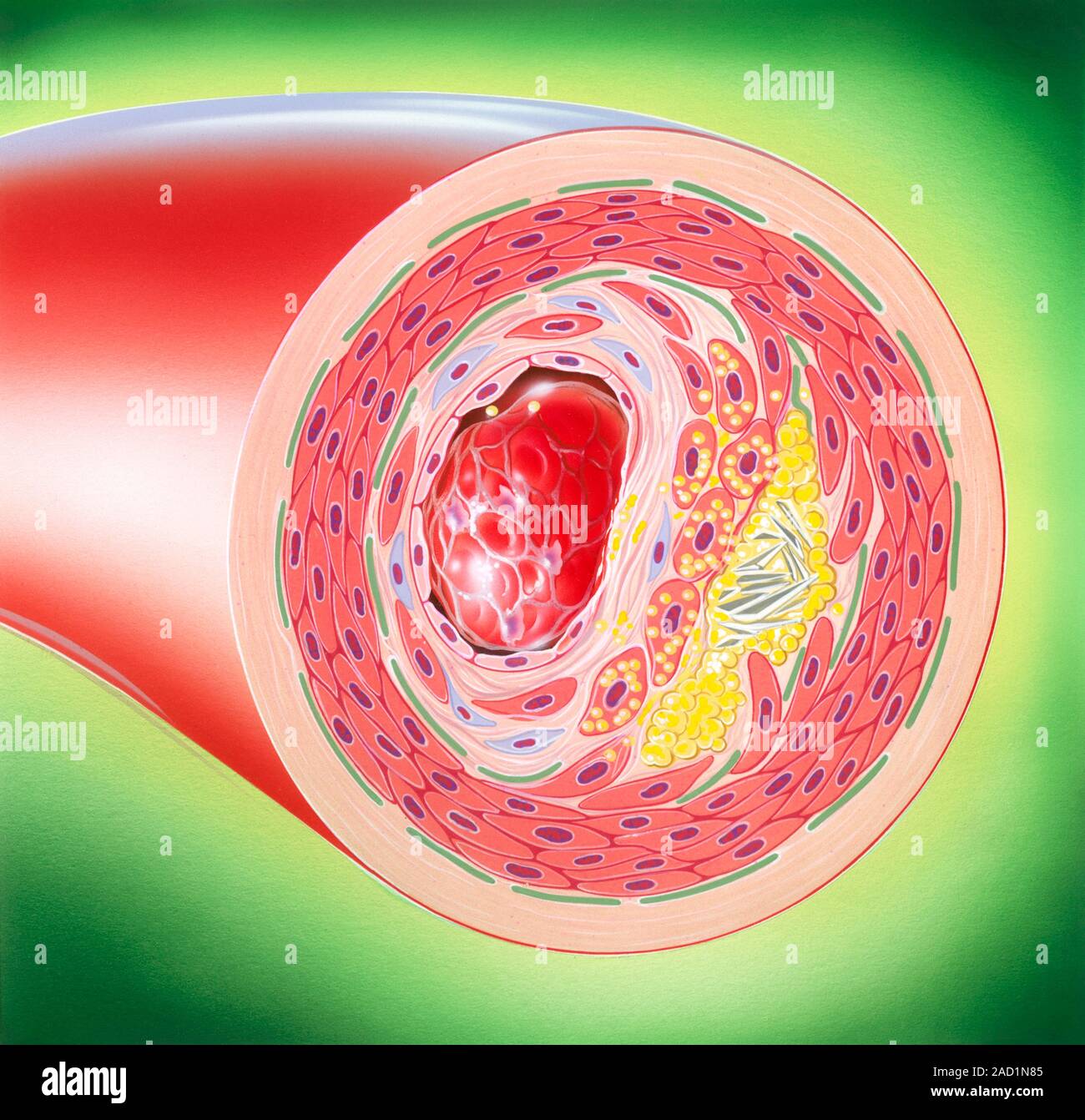 Atherosclerosis. Illustration of a cross-section through an artery that ...