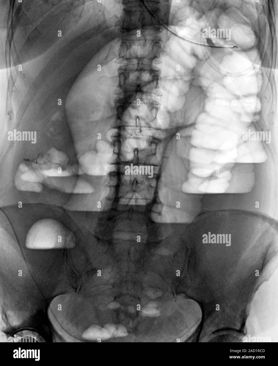 Abdominal blockage. X-ray of a section through the abdomen of a 69-year ...