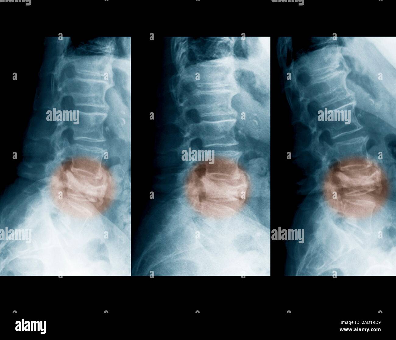 Spinal compression fractures. Xrays of a section through the lower