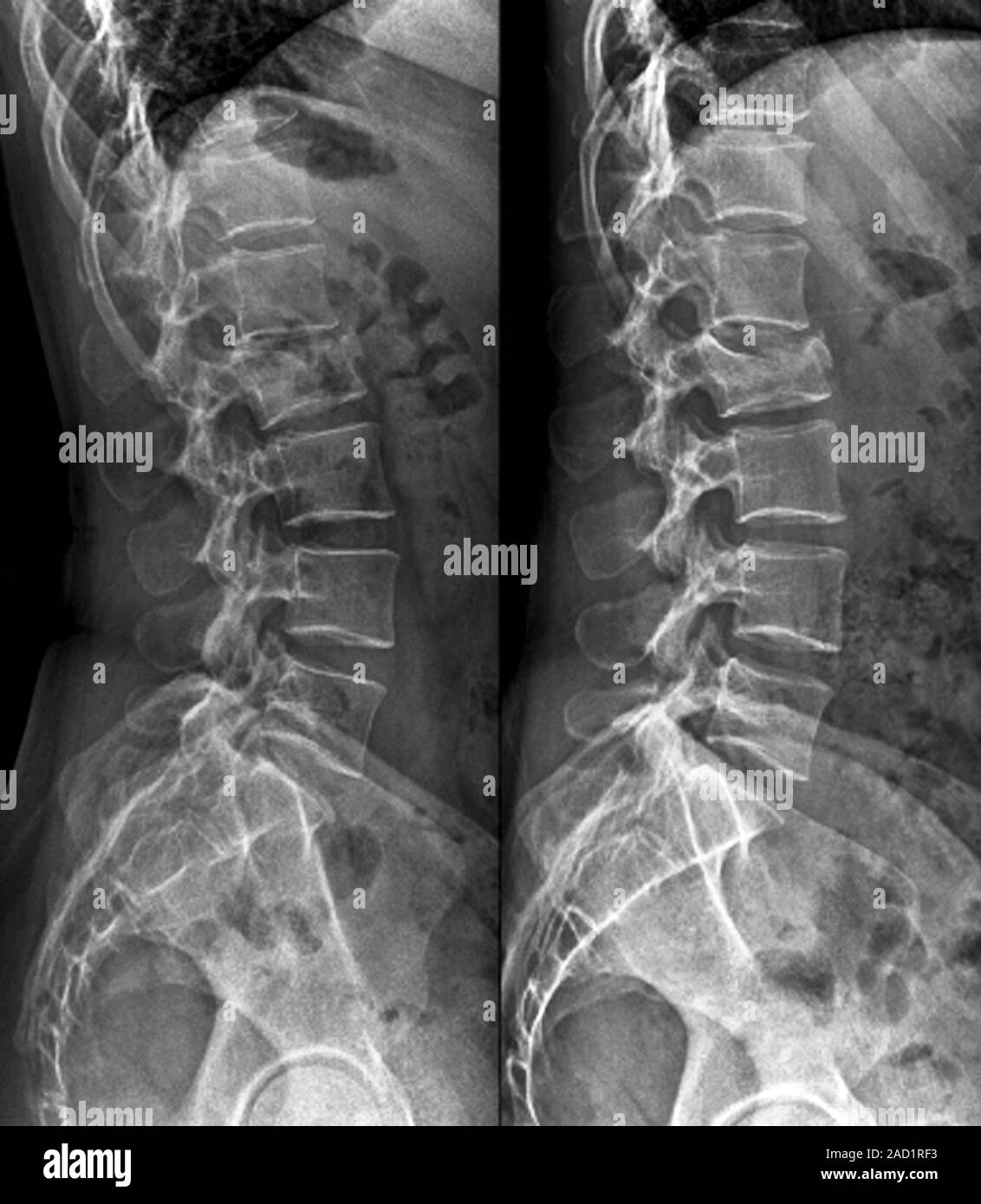 Untreated fractured vertebra. X-rays of sections through the spine of a ...