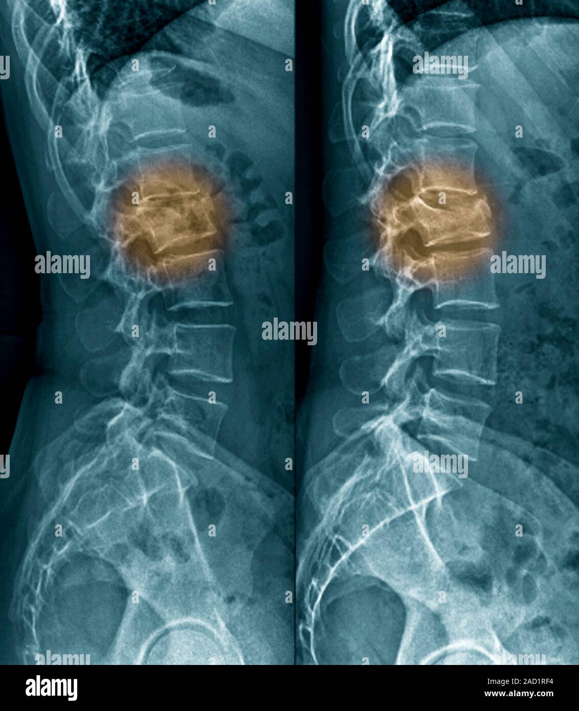 Untreated fractured vertebra. Coloured Xrays of sections through the