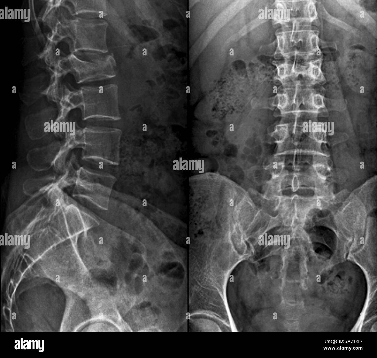 Untreated fractured vertebra. Coloured Xrays of sections through the