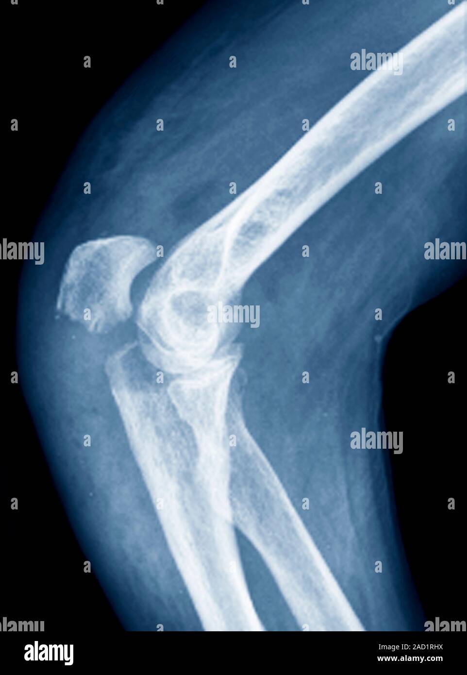 Elbow fracture. Xray of the elbow of a 76yearold patient with a