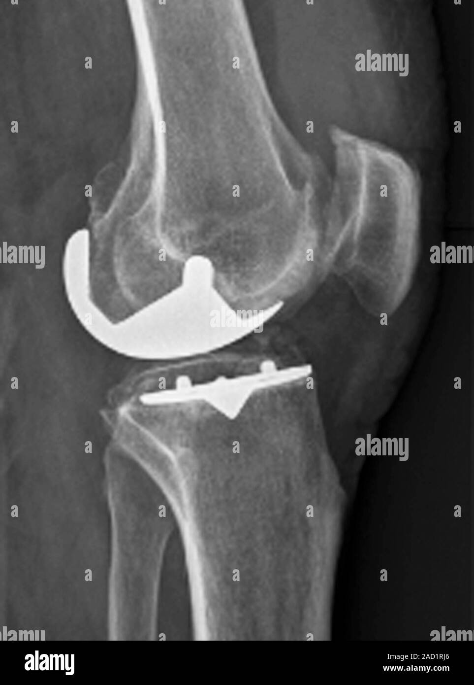 Partial knee replacement. X-ray of the left knee of a 58-year-old ...