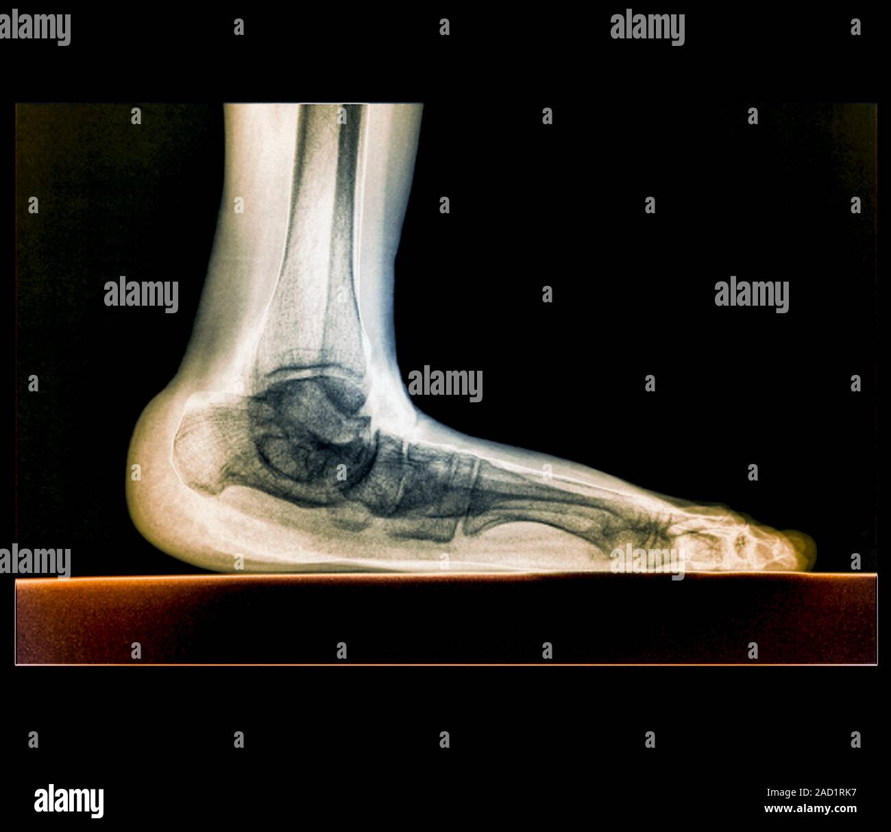 Flat foot. Coloured X ray of the left foot of a 61 year old