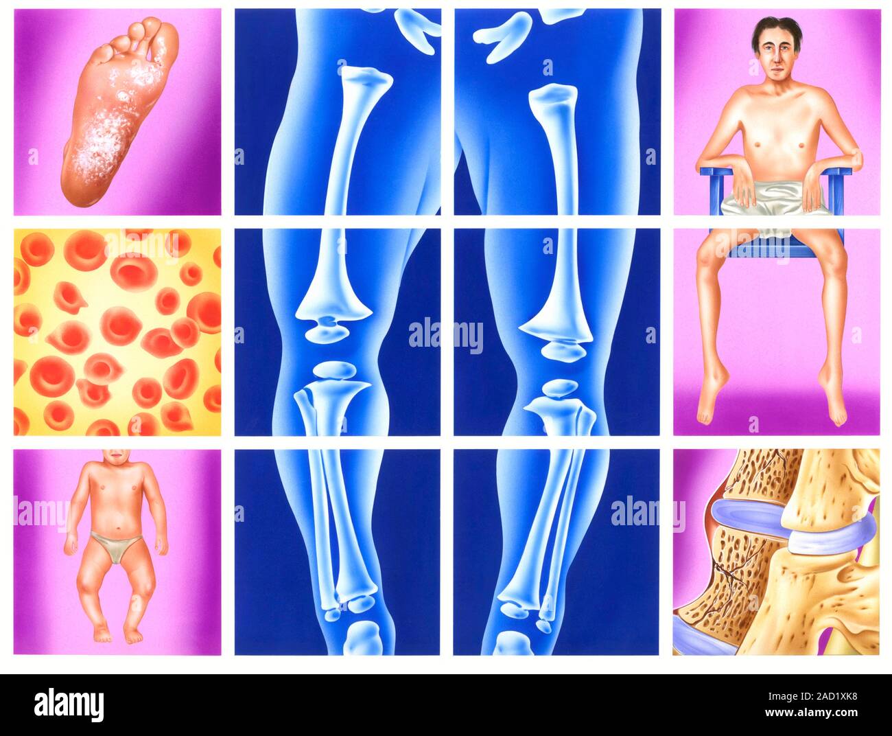 Vitamin deficiency symptoms. Illustration of symptoms that can be