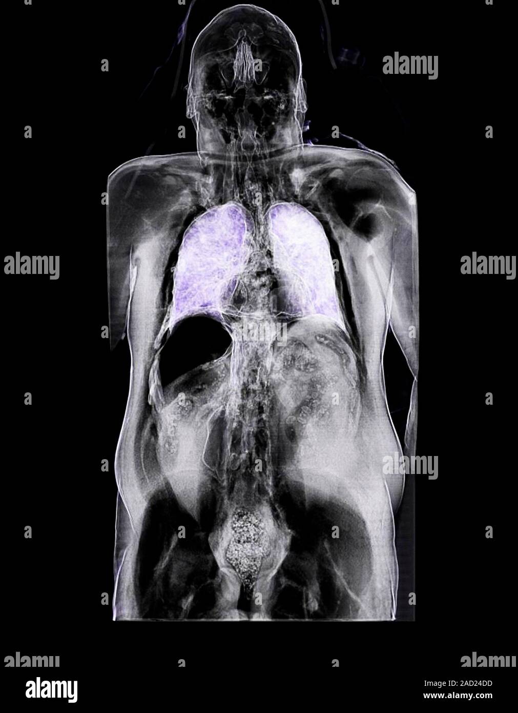 Trapped abdominal gas, computed tomography (CT) scan. Air pockets in
