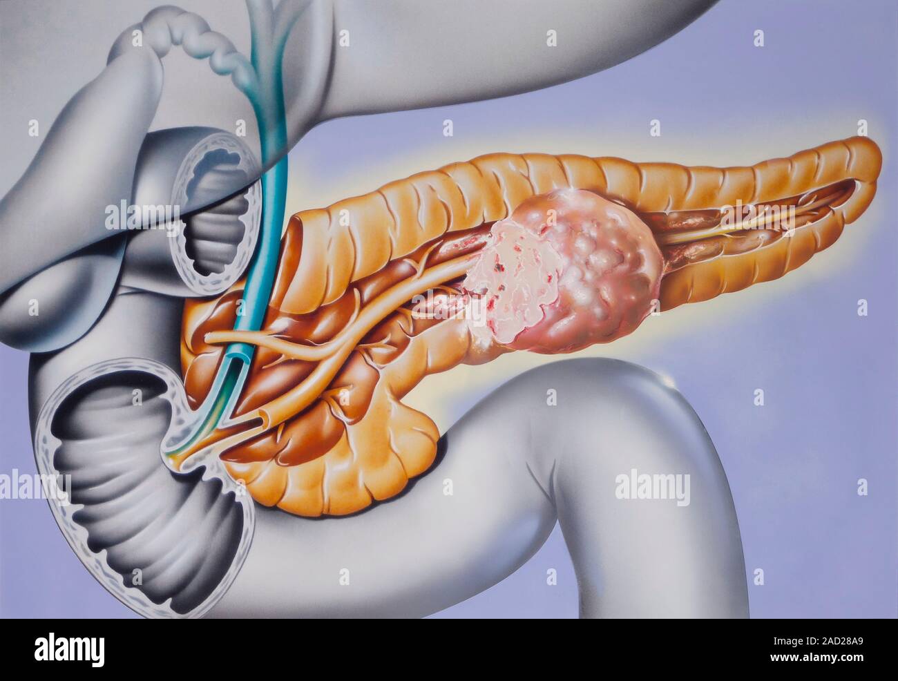 Pancreatic cancer. Computer illustration showing a malignant (cancerous) growth (pink) in the