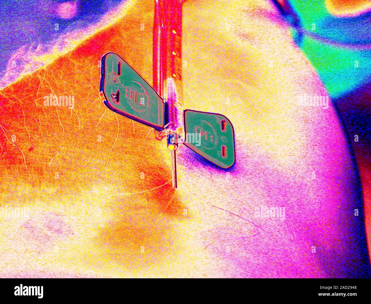 Drawing blood with a butterfly catheter. Abstract coloured image of a