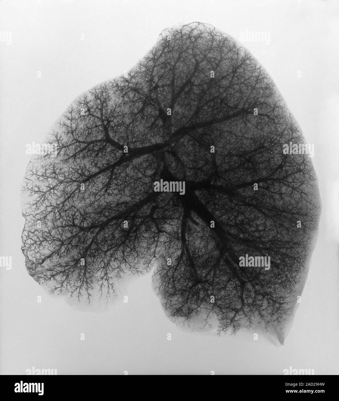 Lung. Xray showing the blood vessels in a lung Stock Photo Alamy