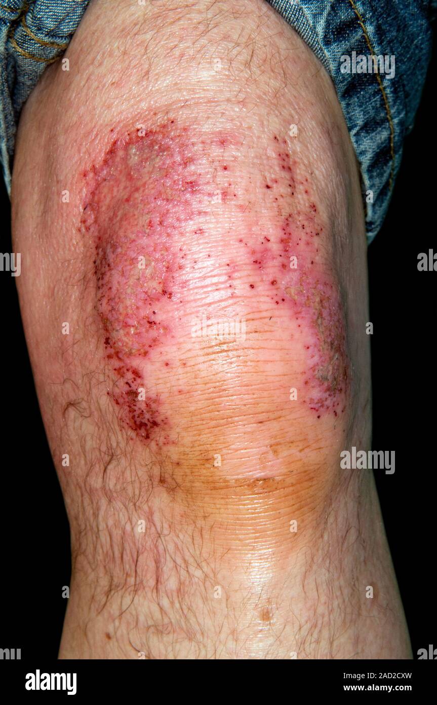 Chemical burns. Close-up of alkali burns on the knee of a 68-year-old
