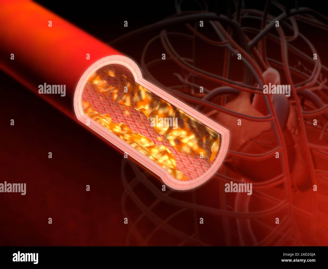 Atherosclerosis. Cutaway computer illustration showing fatty plaques