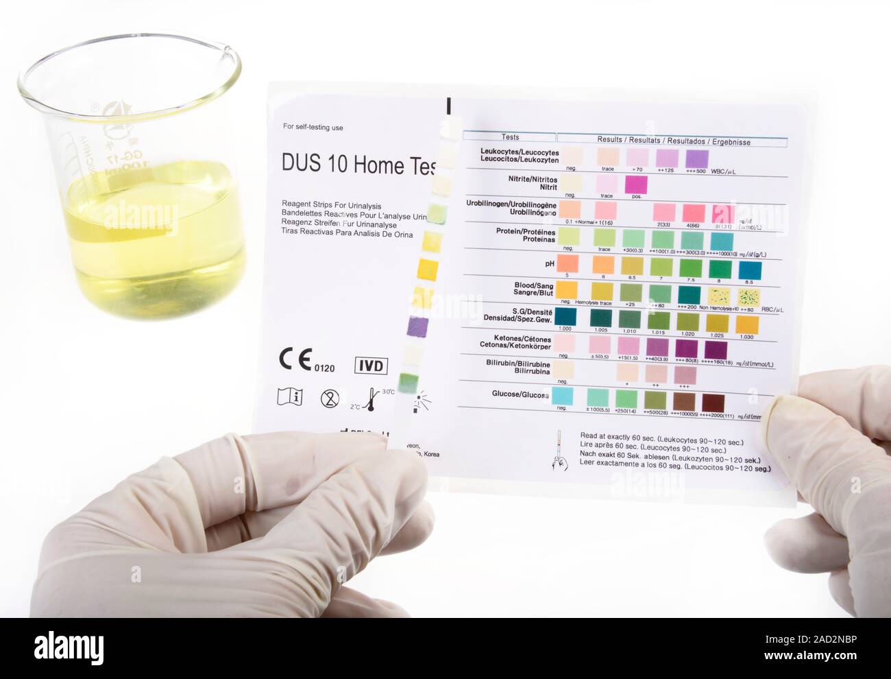 Home urine test, abnormal result. Home test kit for testing urine for
