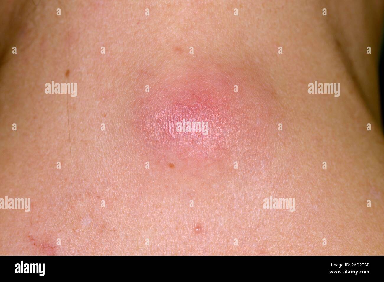 Infected sebaceous cyst. Closeup of an infected sebaceous cyst on the