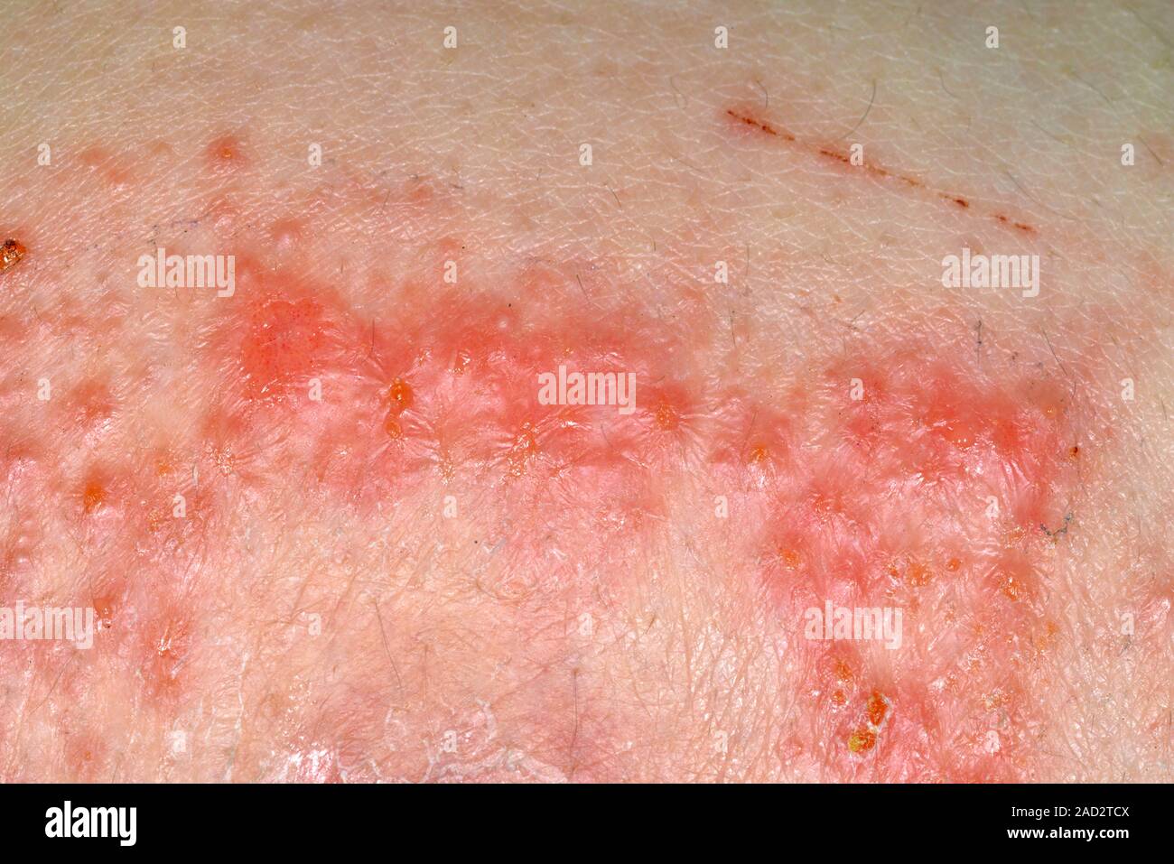 Allergic reaction to dressing adhesive. Closeup a rash on the back of