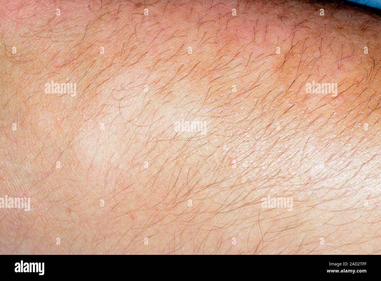 Pityriasis versicolor. Close-up of patches on the skin of a 19-year-old female patient with pityriasis versicolor. Also known as tinea versicolor, thi Stock Photo