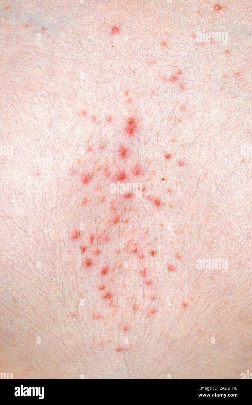 Acneiform rash. Closeup of an acneiform rash on the chest of a 13year