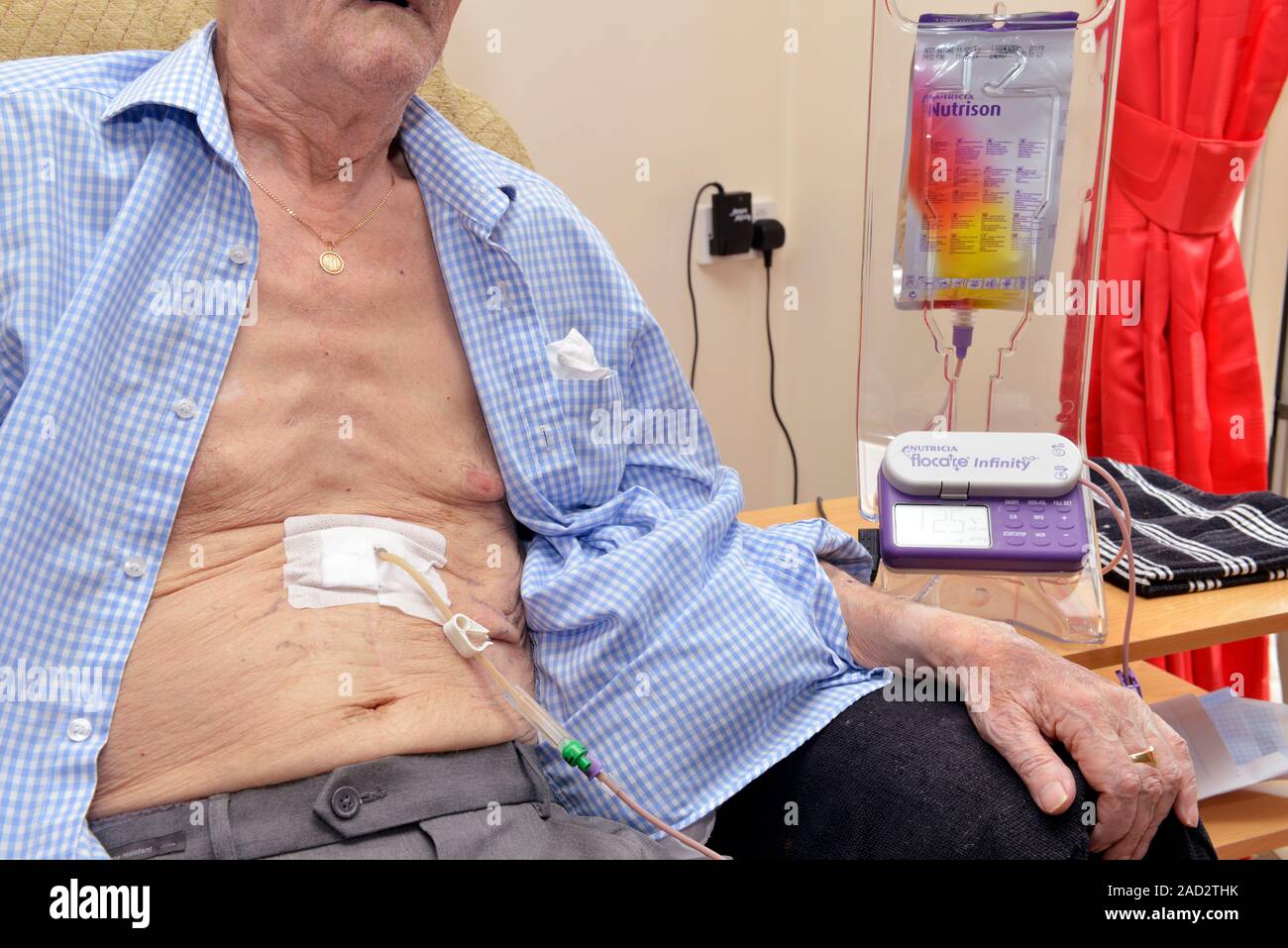 Percutaneous endoscopic gastrostomy. PEG (percutaneous endoscopic