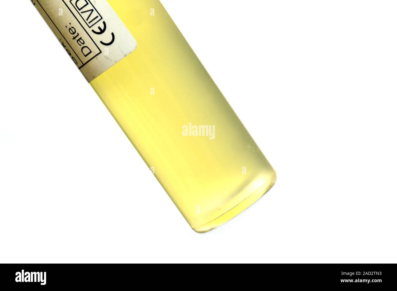 Pseudogout fluid from knee. Vial of fluid aspirated (removed) from the