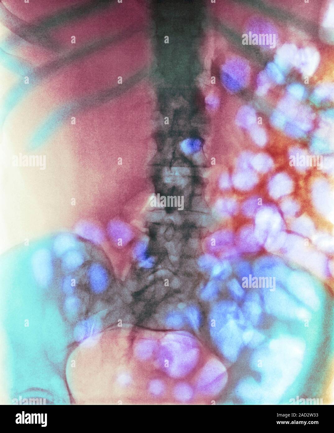 Distended bowel in alcohol and drug abuse. Coloured Xray of a section