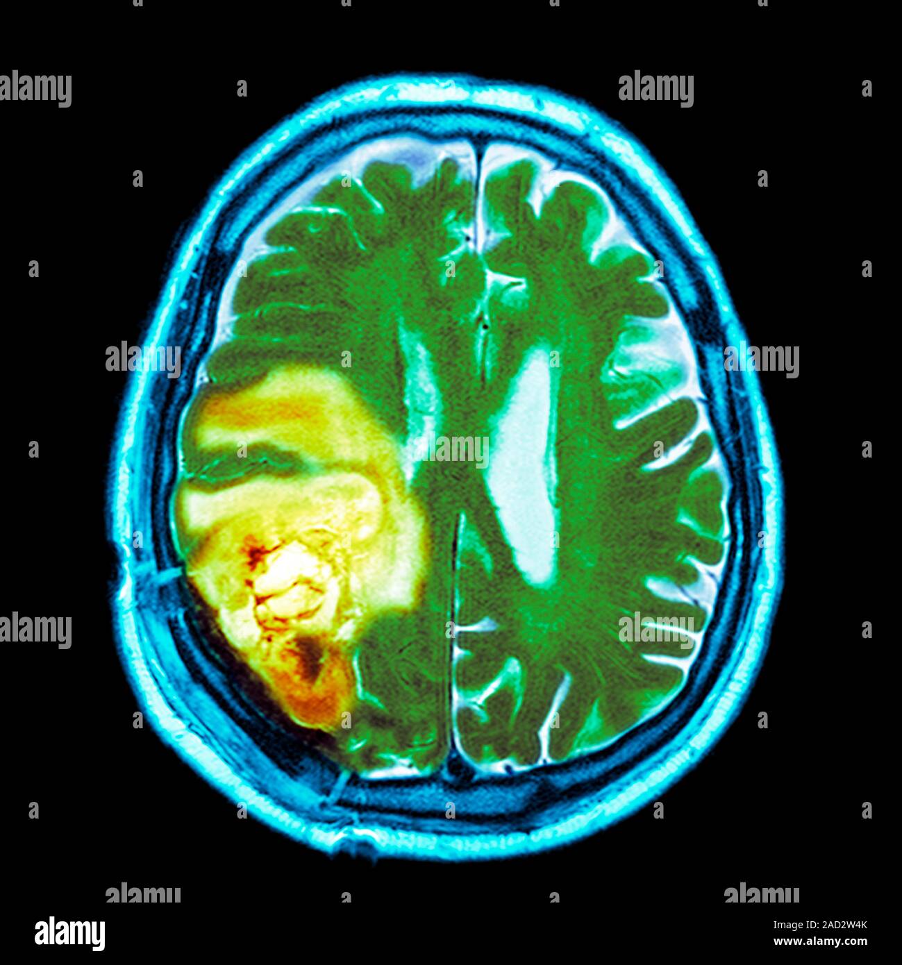 Brain cancer. Coloured magnetic resonance imaging (MRI) scan of a ...
