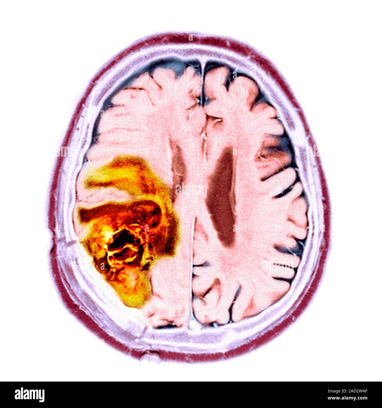 Brain cancer. Coloured magnetic resonance imaging (MRI) scan of a ...