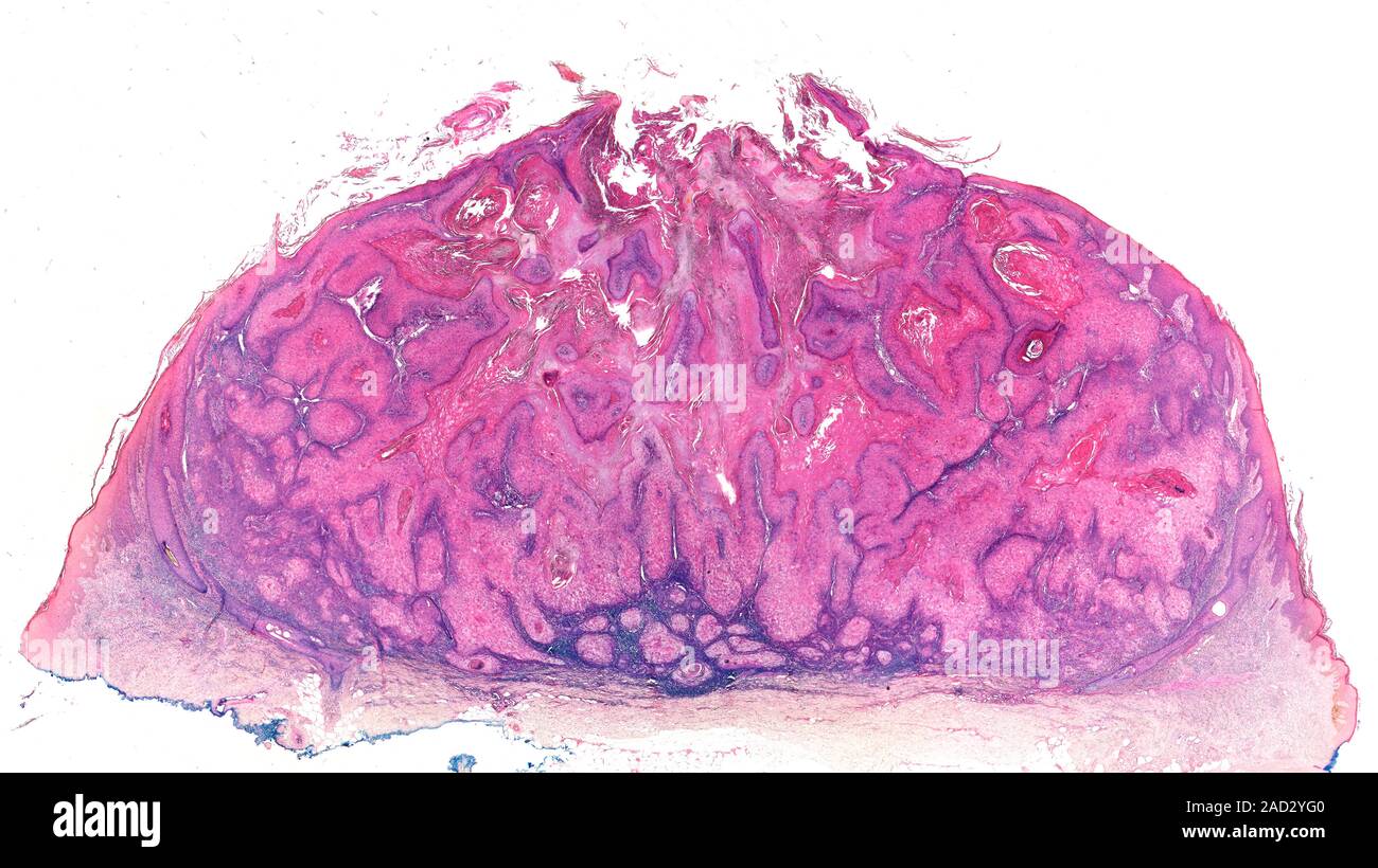 Human skin tumour classified as a squamous keratoacanthoma. This is a