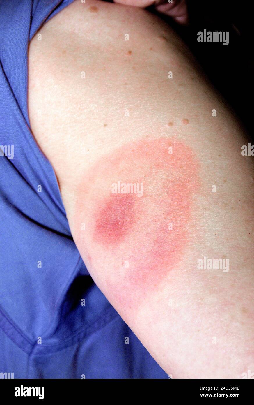 Lyme disease rash. Close-up of the upper arm of a female patient ...