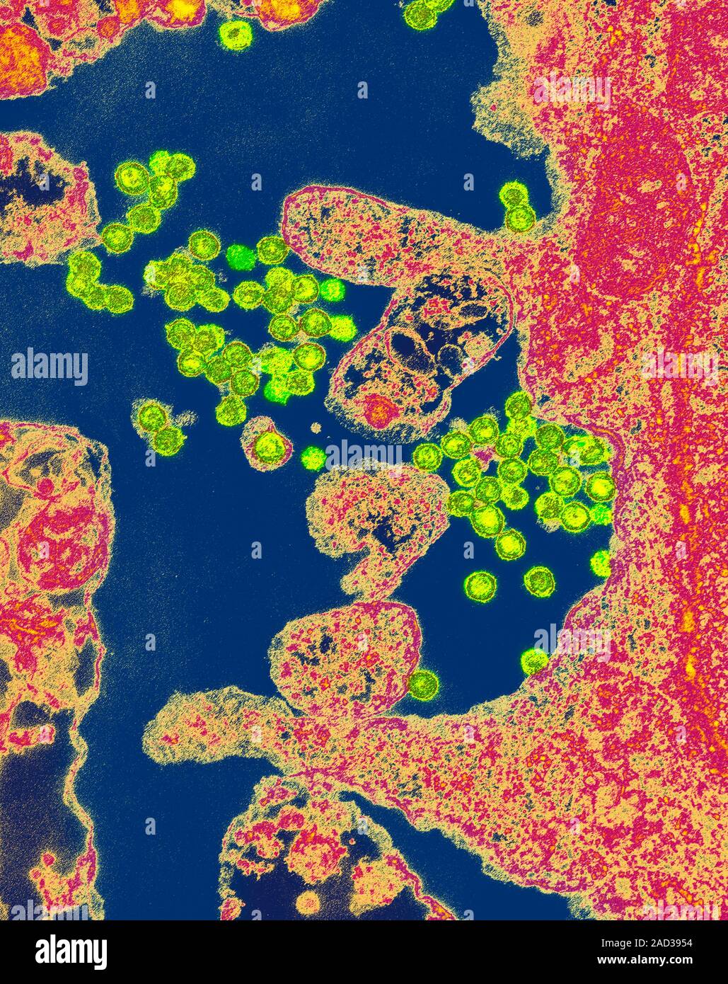 Rous sarcoma virus (RSV) infection, coloured transmission electron micrograph (TEM). The virus particles (green) are in the process of being released Stock Photo