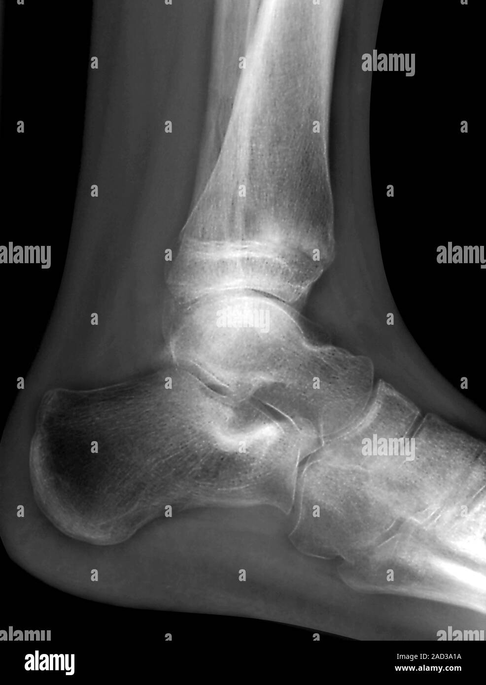 Leg fracture. X-ray of a section through the right ankle of a 13-year ...